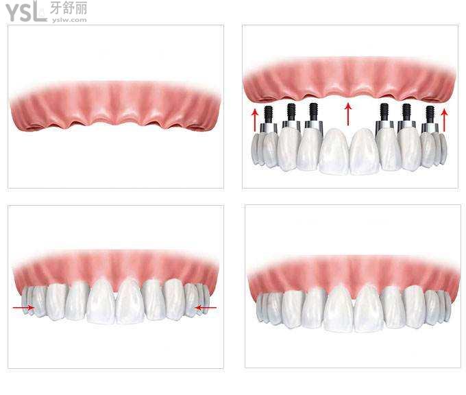 新年大礼包,广州雅度口腔种植牙价格表公开(植体 基台