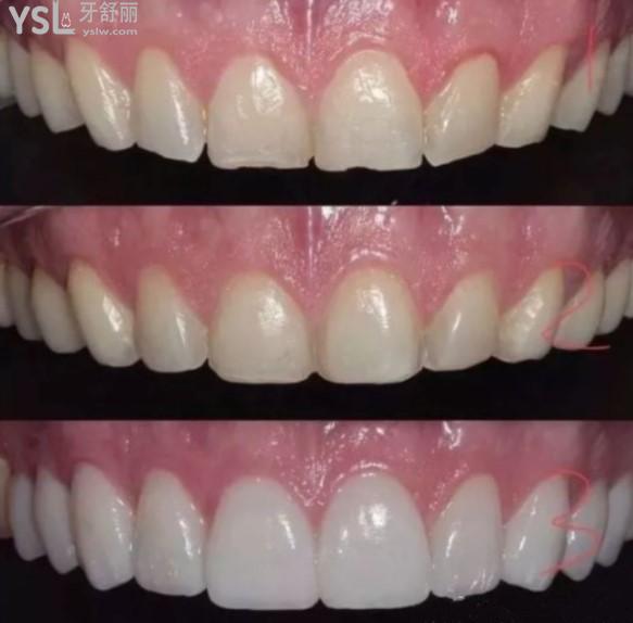 更新西安牙科医院前十位及西安画美口腔emax全瓷贴面价目表