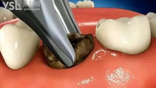 拔烂牙根的过程:1:分离出来牙龈2:挺松患牙3:放置牙钳4:拔掉患牙对于