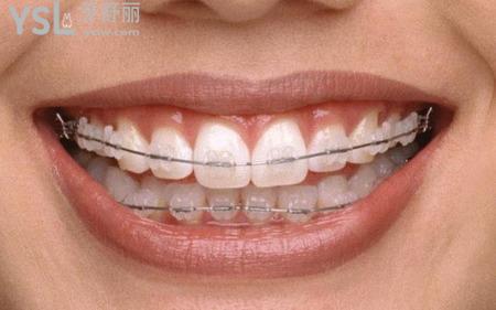 网友138***9955提问:陶瓷自锁牙套的弊端多不多?