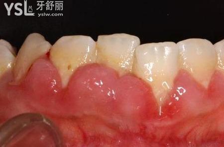 网友1388856提问牙槽脓肿和牙周脓肿的区别在那
