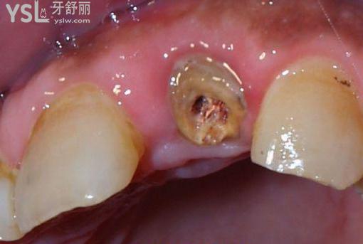 残根