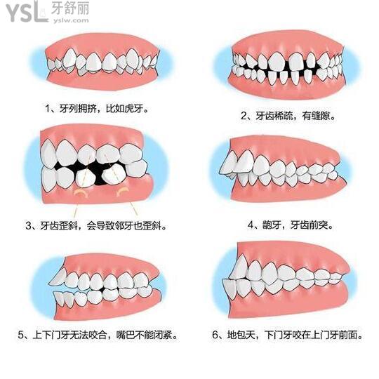 我都30岁了 有深覆合矫正还有必要吗?效果好不好