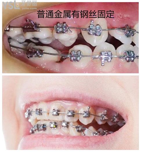 舒适度传统金属托槽价格便宜,是牙齿矫正类型里是价格比较便宜的,所