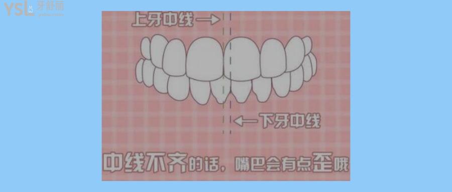 矫正牙齿中线不齐要紧吗?有什么影响?
