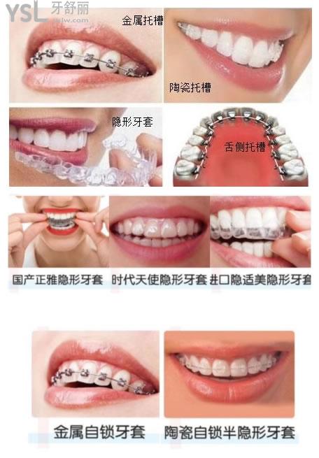 曝光成人牙齿矫正的价格金属牙套和隐形牙套哪个矫正力度大
