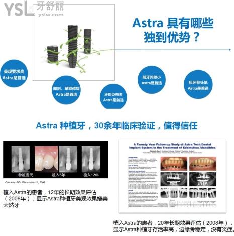 astra和诺贝尔/nobel区别及价格大揭秘_"牙舒丽网发布"的资讯案例