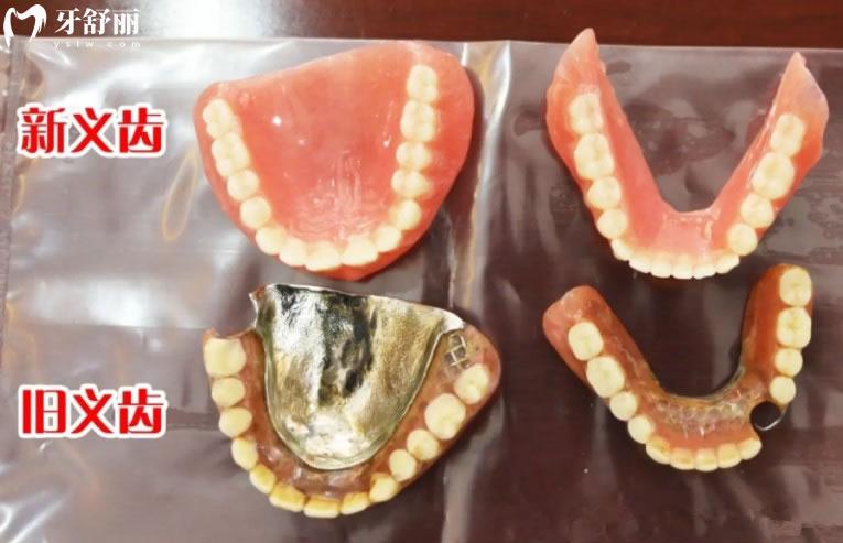 吸附性义齿和普通义齿对比图