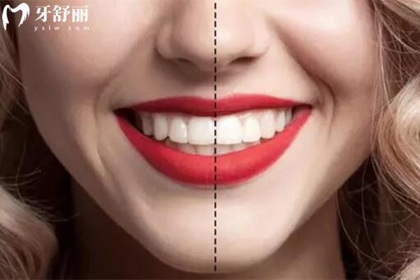 牙齿中线不齐是什么意思？