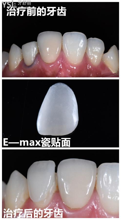 刚更新的广州瑞德口腔emax铸瓷贴面价目表及优势