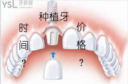 天津美奥口腔种植牙价格