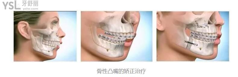 骨性凸嘴的矫正治疗过程