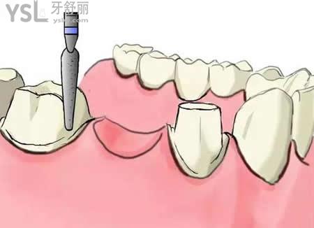 种植牙术后维护？