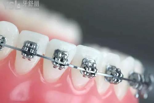 自锁矫正器：