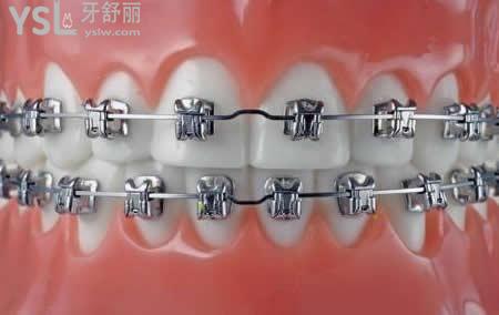 自锁矫正相对于传统矫正有哪些优点：