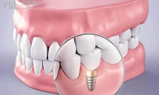 上海百仕口腔门诊部种植牙