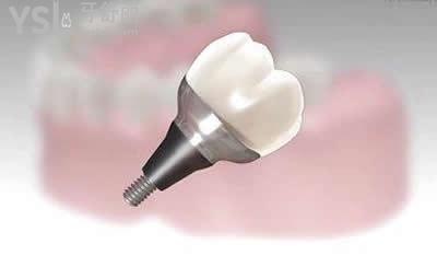 登腾种植牙的优势：