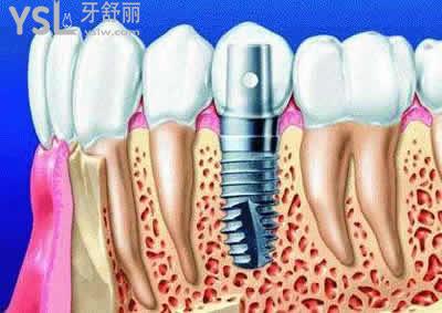 种植牙价格相差这么多的区别在哪？