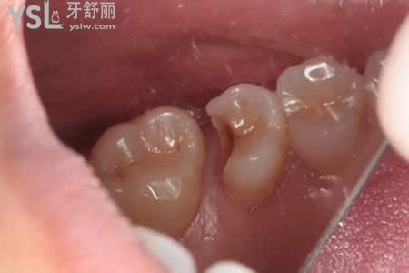 树脂补牙材料好吗？