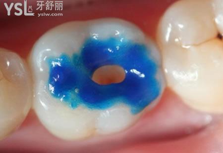 补牙后需要注意那些事情