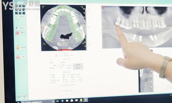 优诺口腔数字化种植牙