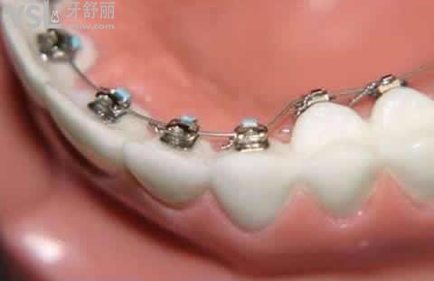 陶瓷矫正的优势：