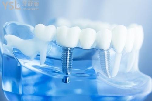 韩国登腾种植体优势：