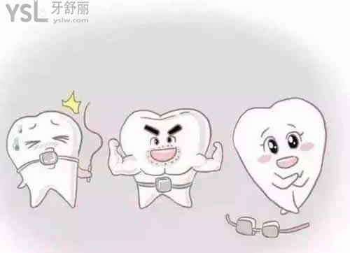 进口3M陶瓷半隐形矫正价格