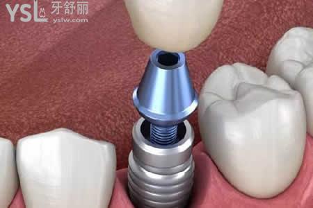 瑞典诺贝尔种植牙：