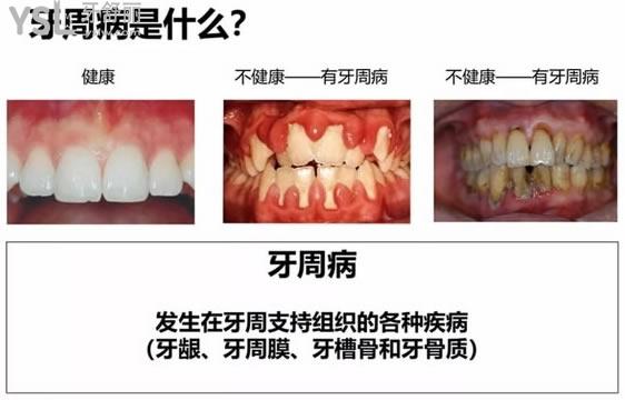 小知齿课堂2020003期，解答中年人牙齿松动脱落是什么病？
