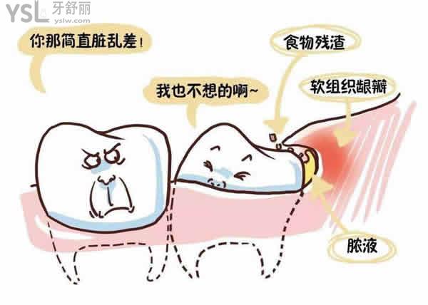 科普67智齿冠周炎能自愈吗告诉你智齿冠周炎消肿小妙招