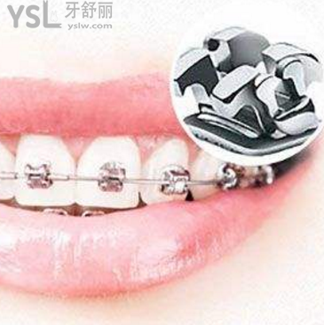 北京自锁牙套多少钱