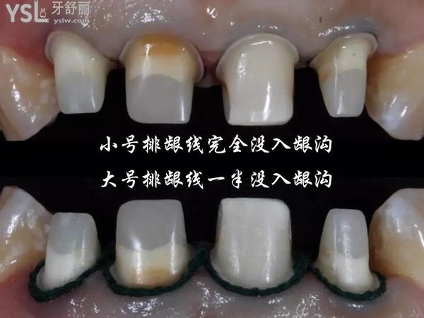 我二十岁烤瓷了17颗牙全瓷牙你为牙齿拼过命吗