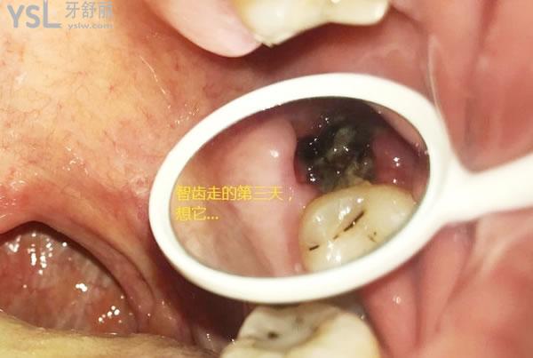 拔牙后窟窿恢复图拔牙3个月的窟窿变化这里都有