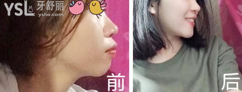 晓萌牙讲座018章：带来带牙套1~12月变化图 (8).jpg