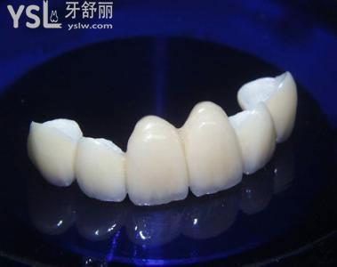 日本则武氧化锆全瓷牙 日本则武氧化锆全瓷牙