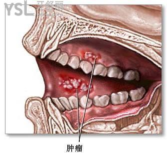 牙龈鳞状细胞癌图片