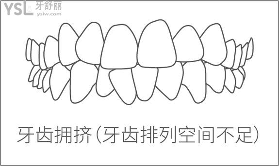 牙齿拥挤
