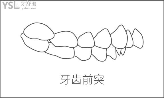 牙齿前突