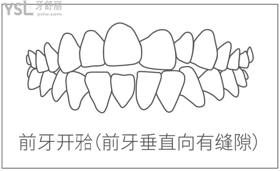 前牙开合