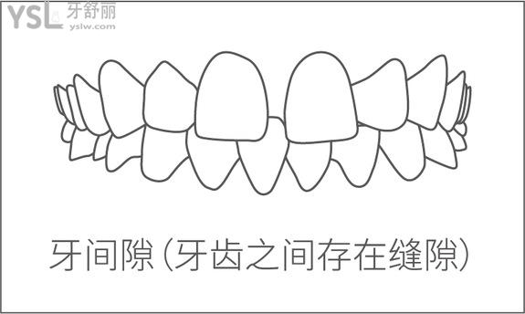 牙间隙