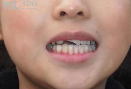 牙齿断了能用树脂补牙吗？