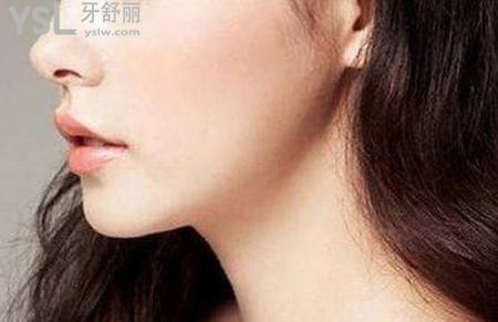 网友1389697提问下巴整形要多少费用