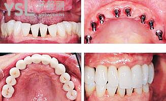 芜湖种植牙多少钱一颗，公开一般选哪个医院比较好
