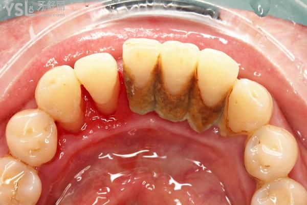 牙周炎是什么症状图片