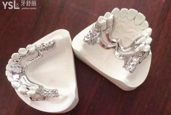 金属材质假牙