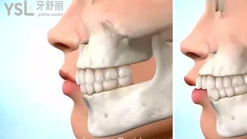 两分钟看懂:天包地要怎么矫正