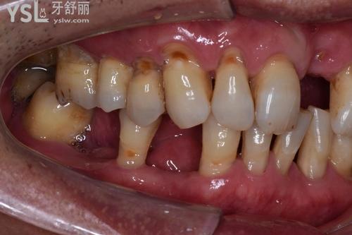 你问我答:牙齿缺失久了还能种植吗(牙齿缺失10年了还可以修复吗)_"牙