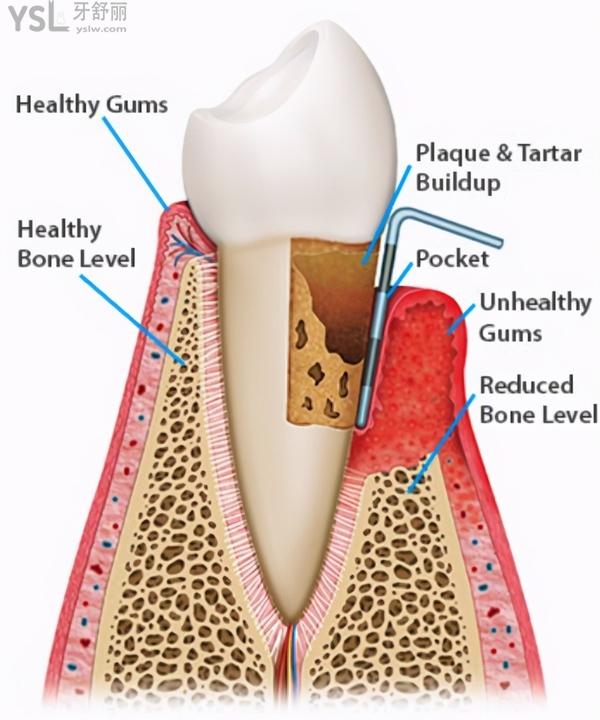 牙周炎治疗注意2