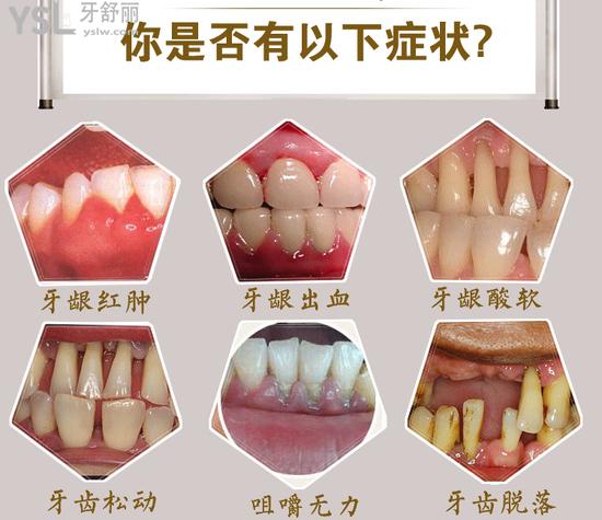 救救孩子吧,牙齿松动牙龈萎缩怎么办啊!